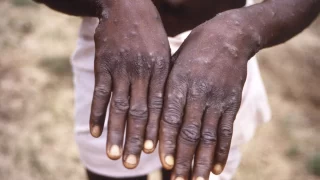 Côte d’Ivoire: 32 cas de mpox, dont un décès, confirmés